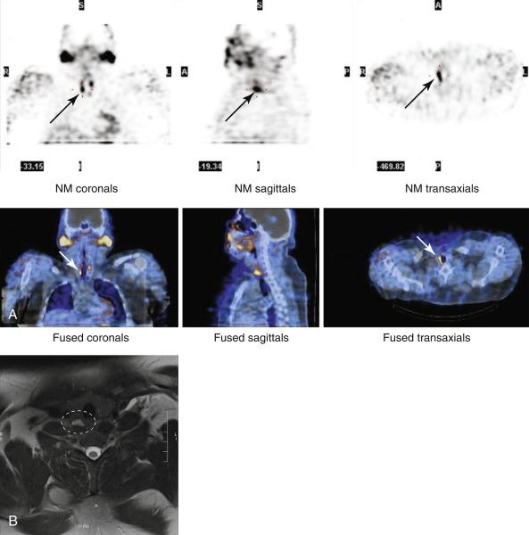 Fig. 54.4, Multigland disease in a patient with persistent hyperparathyroidism. He had multiple endocrine neoplasia type 1 (MEN 1) and a failed bilateral neck exploration. A, Combined single-photon emission computed tomography/computed tomography (SPECT/CT) and 99mTc-sestamibi (MIBI) demonstrate two areas of persistent focal uptake in the lower right and lower left thyroid beds consistent with double parathyroid adenomas. B, Fat-suppressed, T2-weighted axial images via magnetic resonance imaging demonstrate a 1.4 × 0.8 cm bilobed structure within the right tracheoesophageal groove at the inferior aspect of the thyroid and a 1 × 0.6 cm structure at the inferoposterior aspect of the left lobe of the thyroid (magnetic resonance image not shown). The patient became normocalcemic after resection of the right upper gland.