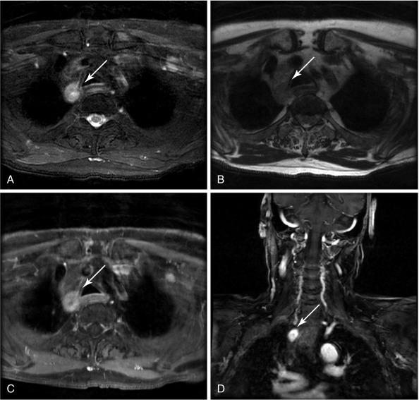 Fig. 54.5, Magnetic resonance imaging (MRI) of the thyroid in a 61-year-old man with primary hyperparathyroidism and in hypercalcemic crisis (Ca 20 mg/dL). A 2.3 × 1.8 × 1.6 cm circumscribed T1 hypointense and T2 hyperintense enhancing mass is seen in the right paratracheal superior mediastinum corresponding to a descended upper right parathyroid adenoma. This lesion was not seen on ultrasound due to a deep posterior location. MRI views include the following: A, axial T2-weighted image with fat saturation ; B, axial T1-weighted image with no fat saturation; C, axial T1 gadolinium-enhanced image with fat saturation; and D, coronal T1 gadolinium-enhanced image with fat saturation. Through a lateral approach, an upper right gland (3.2 × 1.7 × 1.3 cm) descended into the posterior mediastinum was found (posteriorly located upper gland [PLUG] giant adenoma). Postoperatively, calcium and parathyroid hormone (PTH) levels dropped appropriately.