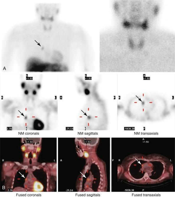 Fig. 54.6, Ectopic mediastinal parathyroid adenoma in a 48-year-old woman with primary hyperparathyroidism. The adenoma was removed successfully with a right thoracoscopic parathyroidectomy. A, Planar sestamibi images demonstrate a focus of increased uptake in the right superior mediastinum. The thyroid gland appears homogeneous. B, Combined single-photon emission computed tomography/computed tomography (SPECT/CT) demonstrates increased uptake in the right superior mediastinum lateral to the right atrium.
