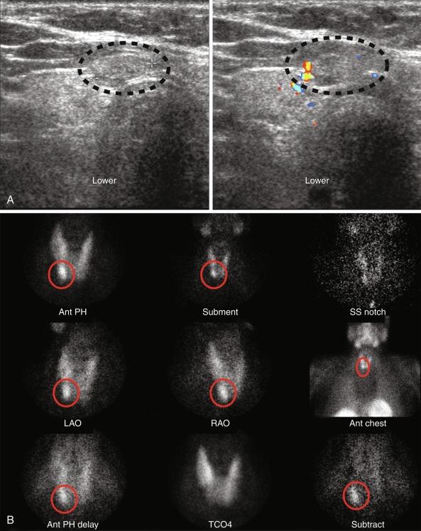 Fig. 54.7, A lower right parathyroid adenoma localized by ultrasound and sestamibi subtraction imaging. A 60-year-old woman with primary hyperparathyroidism had concordant 99mTc-sestamibi (MIBI) and ultrasound studies. She had a successful lower right parathyroidectomy via a focused anterior approach. A, Ultrasound showed a 2 × 1.3 × 0.8 cm hypoechoic nodule at the level of the lower right pole of the thyroid. B, Sestamibi subtraction imaging showed a right inferior parathyroid adenoma, consistent with ultrasound findings.