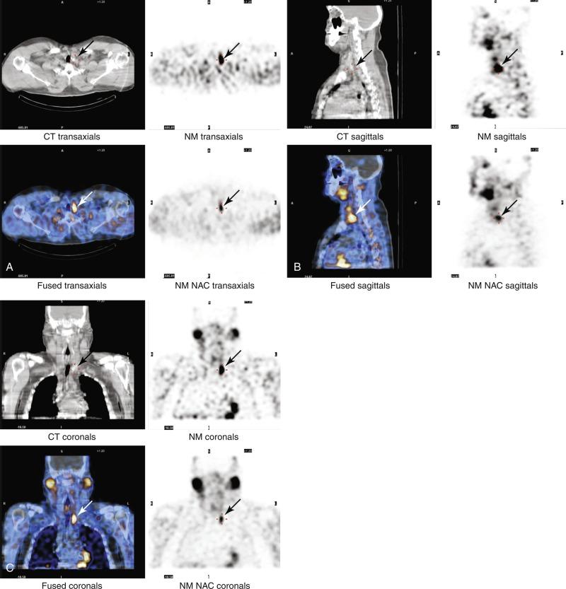 Fig. 54.8, Combined single-photon emission computed tomography/computed tomography (SPECT/CT) and sestamibi scan of a 43-year-old man with primary hyperparathyroidism. SPECT/CT views of the neck with Tc-99m sestamibi. Axial (A); sagittal (B); and coronal (C) views. Persistent focal uptake of sestamibi in the lower left thyroid bed is consistent with a parathyroid adenoma. Intraoperatively, this patient was found to have a upper left parathyroid adenoma.