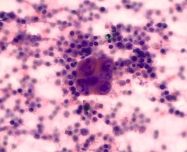 Figure 2-1, Example of rapid-fixed, hematoxylin-and-eosin–stained slide. Pancreatic adenocarcinoma metastatic to lymph node.