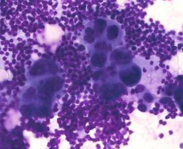 Figure 2-2, Example of air-dried, Romanowsky-stained slide. Same case as illustrated in Figure 2-1 .