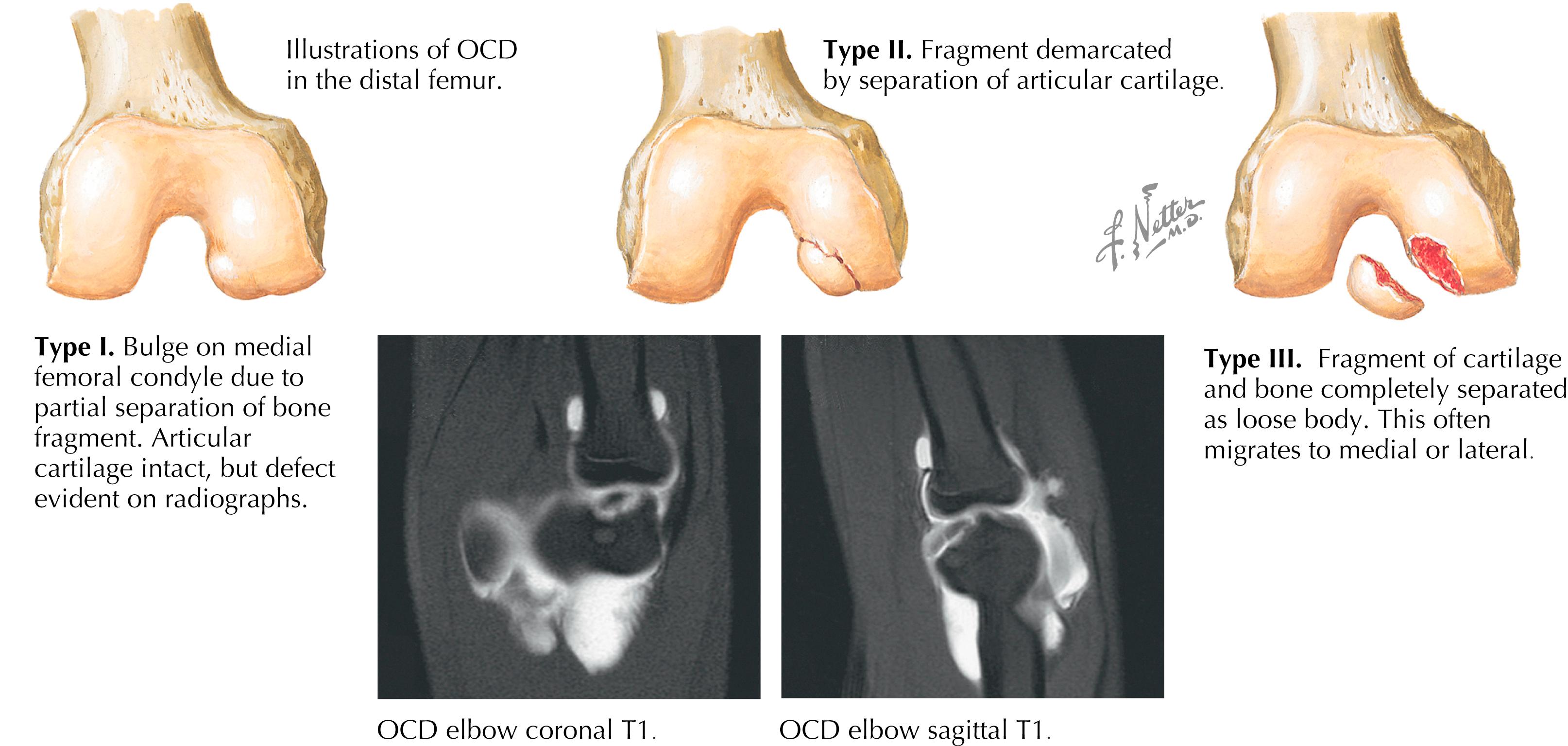 Figure 90.1, Capitellar osteochondritis dissecans.