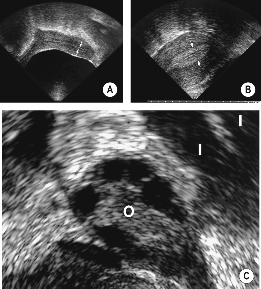 (A) Transvaginal US shows normal endometrium (arrows) in proliferative phase and (B) in follicular phase (arrows). (C) Sagittal transvaginal US shows a normal ovary (O) with follicles. Note the location of the ovary anterior and medial to the internal iliac vessels (I) within the ovarian fossa. *