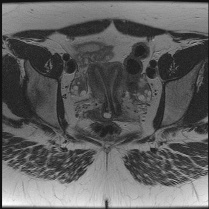 Uterus didelphys. T2-weighted axial oblique MRI elegantly demonstrates two separate normal-sized uterine horns and cervices. **