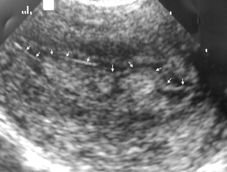 TVUS. Multiple endometrial polyps. Note the midline echoes due to the endometrial interface (arrows) displaced by the polyps. This is a useful feature in differentiating polyps from endometrial hyperplasia. †