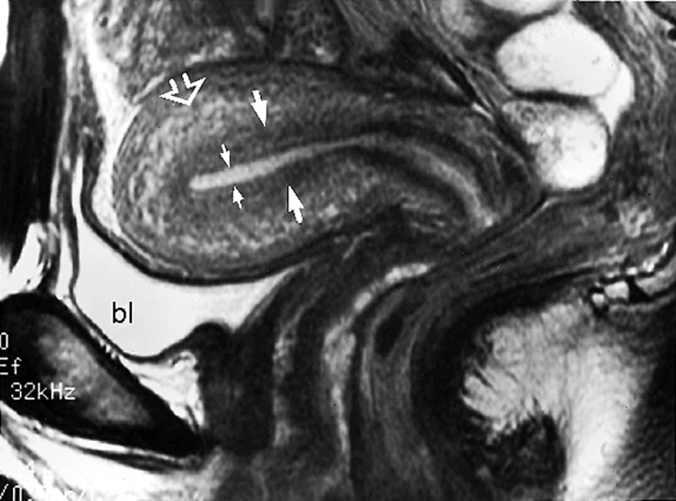 Zonal anatomy of the uterus. Sagittal T2WI. The central, high SI stripe represents the endometrium (small arrows) ▸ the band of low SI subjacent to the endometrial stripe represents the inner myometrium or junctional zone (arrows). The outer layer of the myometrium is of intermediate SI (open arrow). bl = bladder. *