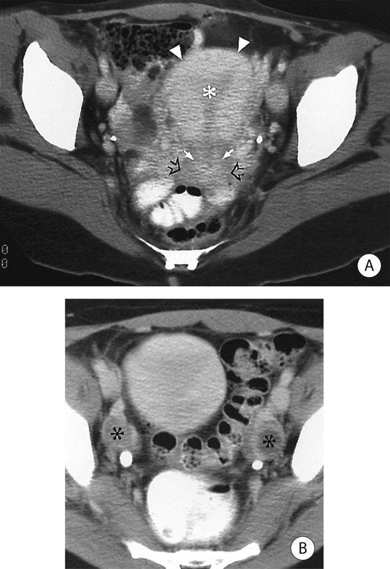 CT. (A) Normal uterus with a low attenuation endometrial canal (*) flanked by enhancing myometrium (arrowheads). Enhancing endocervical mucosa (short solid white arrows) surrounds the endocervical canal. The fibrous cervical stroma (open black arrows) enhances less than the uterine corpus myometrium. (B) Bilateral physiological ovarian cysts (*) in their expected location (anterior to the internal iliac vessels and posterior to the external iliac vessels). *