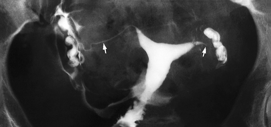 Normal hysterosalpingogram. Cervix and uterine body are delineated by contrast media. Both Fallopian tubes are shown (arrows), with early peritoneal spill. *