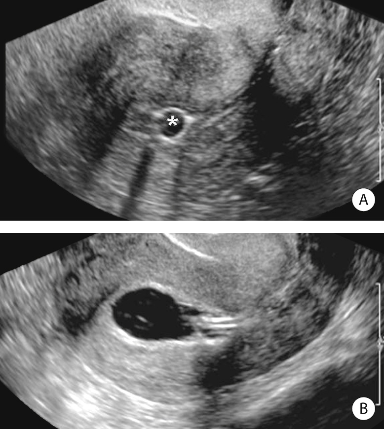 Sonohysterography. Sagittal transvaginal US (A) demonstrates the inflated balloon of the sonohysterographic catheter (*) within the endometrial canal. Following the instillation of 40 ml of sterile saline (B), fluid distends the endometrial canal. *