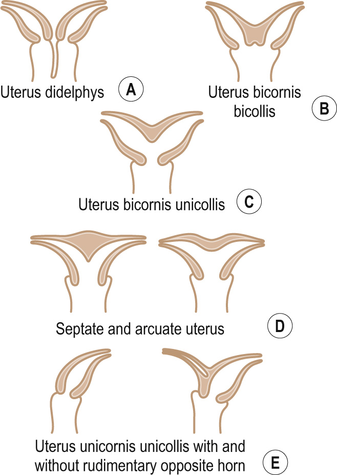 Congenital abnormalities of the uterus.