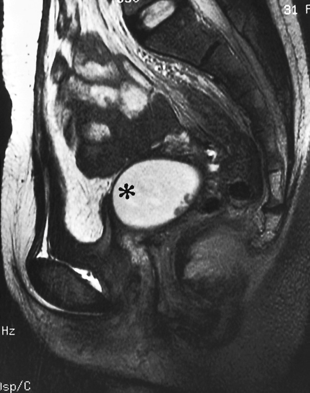 Vaginal septum. Sagittal T2WI shows the presence of haematometra (*) caused by a transverse vaginal septum. *