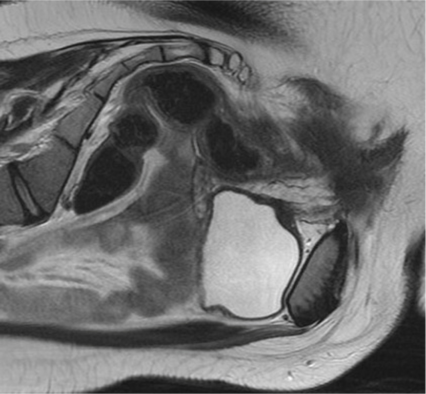 Uterus bicornuate. Coronal T2WI demonstrating two endometrial canals (*). *