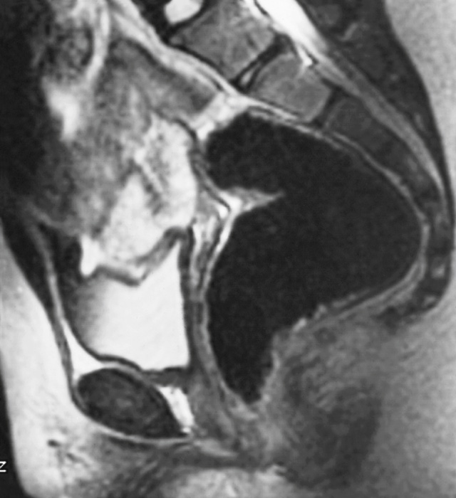 Absence of the uterus. Sagittal T2WI shows no uterine tissue. *