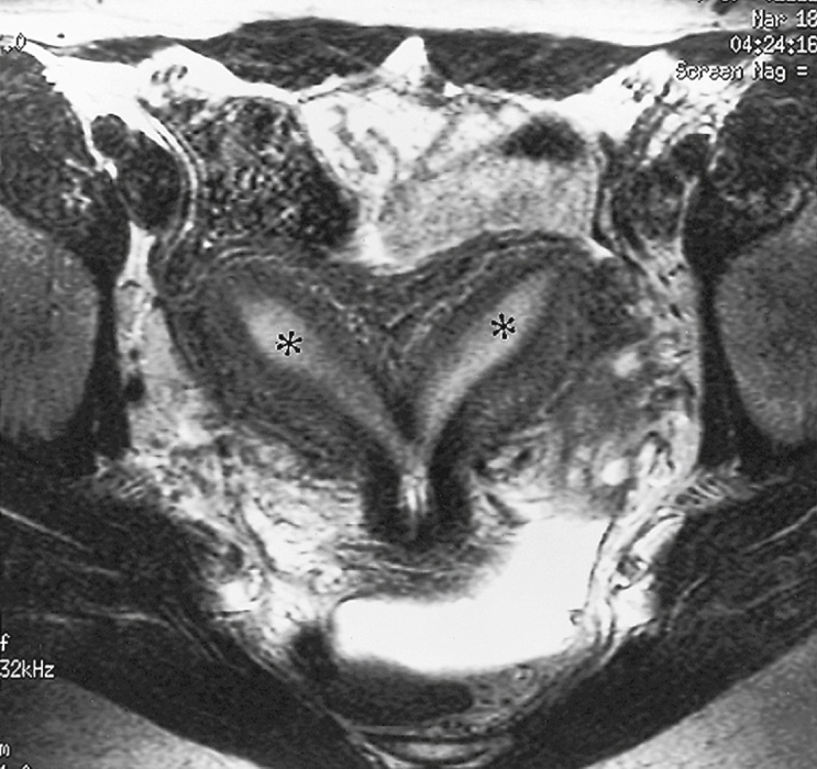 Uterine and vaginal agenesis. Sagittal T2-weighted MRI of the pelvis showing absent uterus and vagina. **