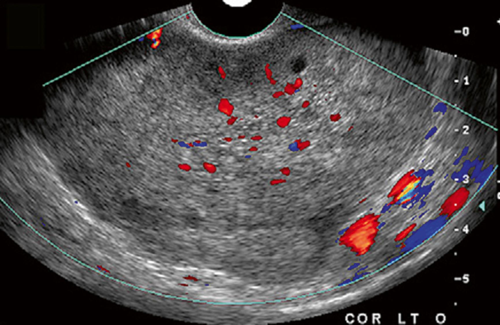 Fig. 86.3, Ovarian torsion with color Doppler image demonstrating venous and arterial flow.
