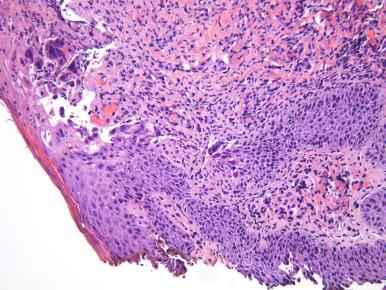 Figure 17.4, Vulvar biopsy with vesicle secondary to herpes simplex virus cytopathic effect in squamous cells (hematoxylin and eosin stain, ×20).