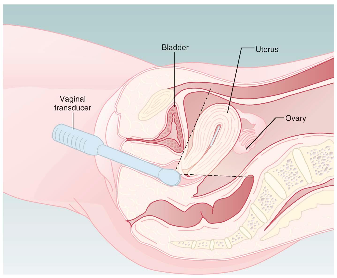 FIGURE 31-1, Placement of the transvaginal ultrasound probe against the uterine cervix to view the uterus and adnexal structures.