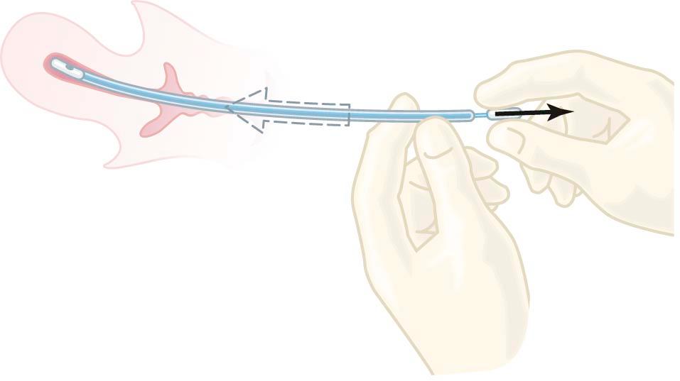 FIGURE 31-2, Endometrial sampling using the Pipelle endometrial suction instrument. A flexible, hollow plastic tube is inserted and held in the uterine cavity as the stylet is withdrawn, creating a vacuum and resulting in aspiration of tissue.