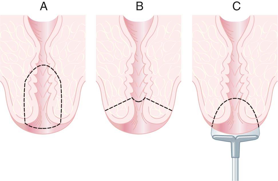 FIGURE 31-3, Cone biopsy of the cervix. A, Diagnostic conization performed when the squamocolumnar junction is not fully visualized colposcopically. B, Therapeutic conization performed for disease involving the exocervix (or ectocervix) and distal endocervical canal. C, Loop electrosurgical excision procedure. The goal of the procedure is to remove the cervical tissue to just above the squamocolumnar junction, including any visible lesions.