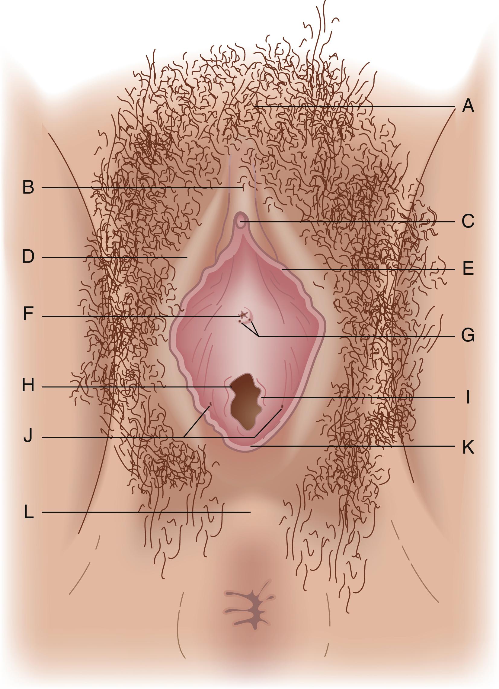 Fig. 71.1, The eternal genitalia. A , Mons pubis; B , prepuce; C , clitoris; D , labia majora; E , labia minora; F , urethral meatus; G , Skene gland ducts; H , vagina; I , hymen; J , Bartholin glands; K , posterior fourchette; L , perineal body.