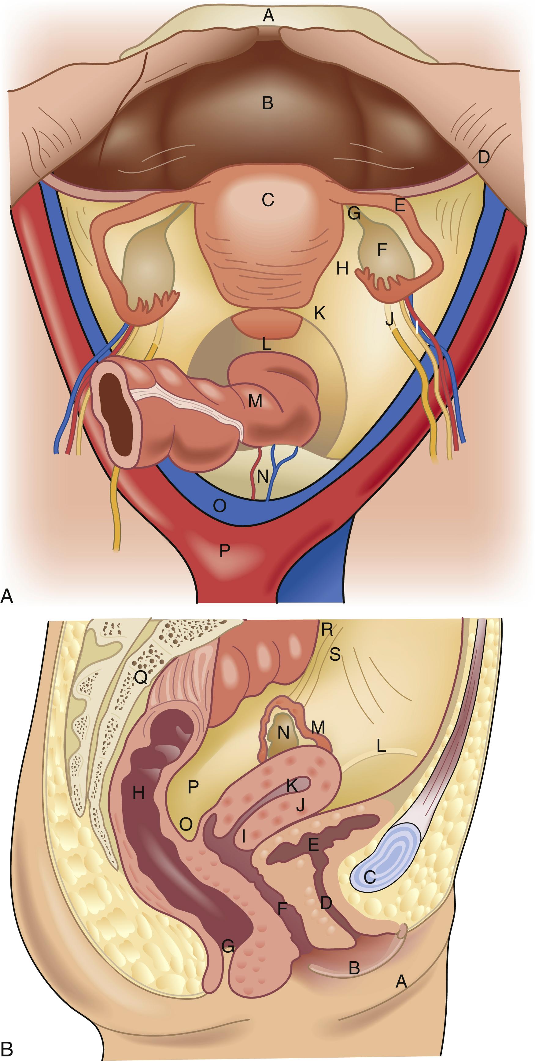 Fig. 71.2, The internal genitalia. (A) A , Symphysis pubis; B , bladder; C , corpus uteri; D , round ligament; E , fallopian tube; F , ovary; G , uteroovarian ligament; H , broad ligament; I , ovarian artery and vein; J , ureter; K , uterosacral ligament; L , cul-de-sac; M , rectum; N , middle sacral artery and vein; O , vena cava; P , aorta. (B) A , Labium majus; B , labium minus; C , symphysis pubis, D , urethra; E , bladder; F , vagina; G , anus; H , rectum; I , cervix uteri; J , corpus uteri; K , endometrial cavity; L, round ligament; M , fallopian tube; N , ovary; O , cul-de-sac; P , uterosacral ligament; Q , sacrum; R , ureter; S , ovarian artery and vein.