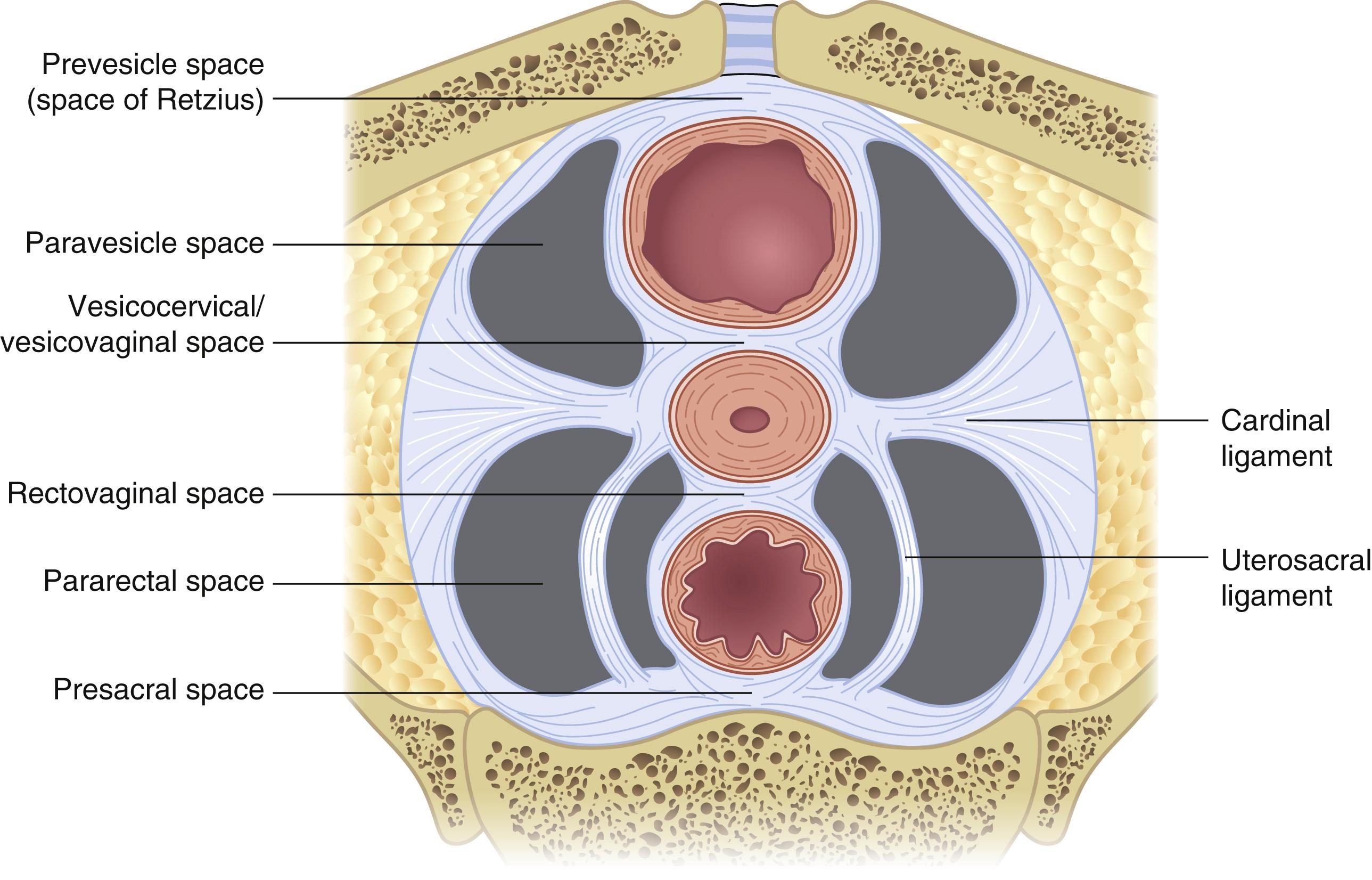 Fig. 71.3, Anatomic spaces of the female pelvis.