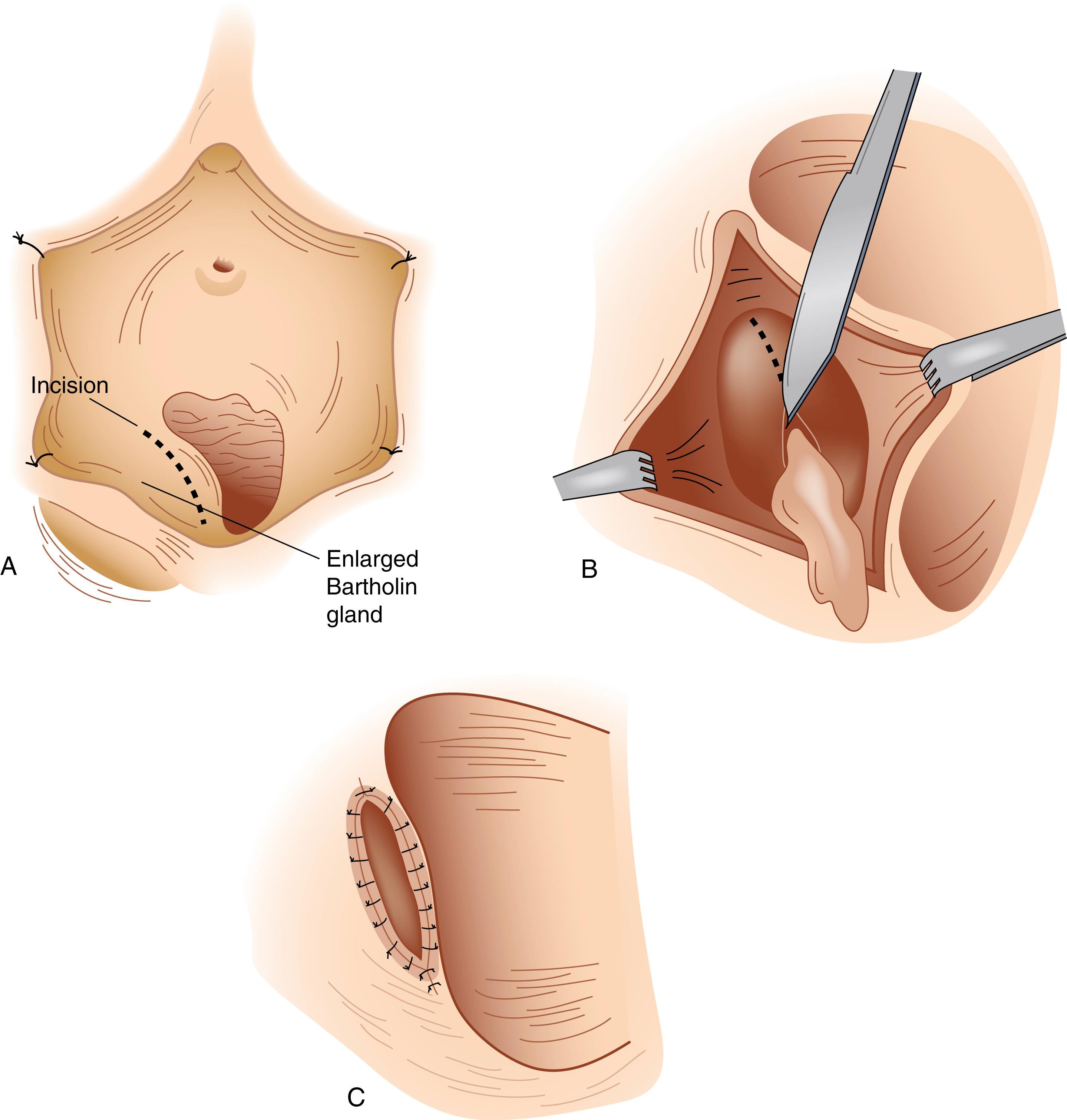 Fig. 71.6, Bartholin gland marsupialization. (A) Retraction of the labia and incision over the mucosa of the vagina. (B) Wall of the gland is excised. (C) Completed marsupialization.