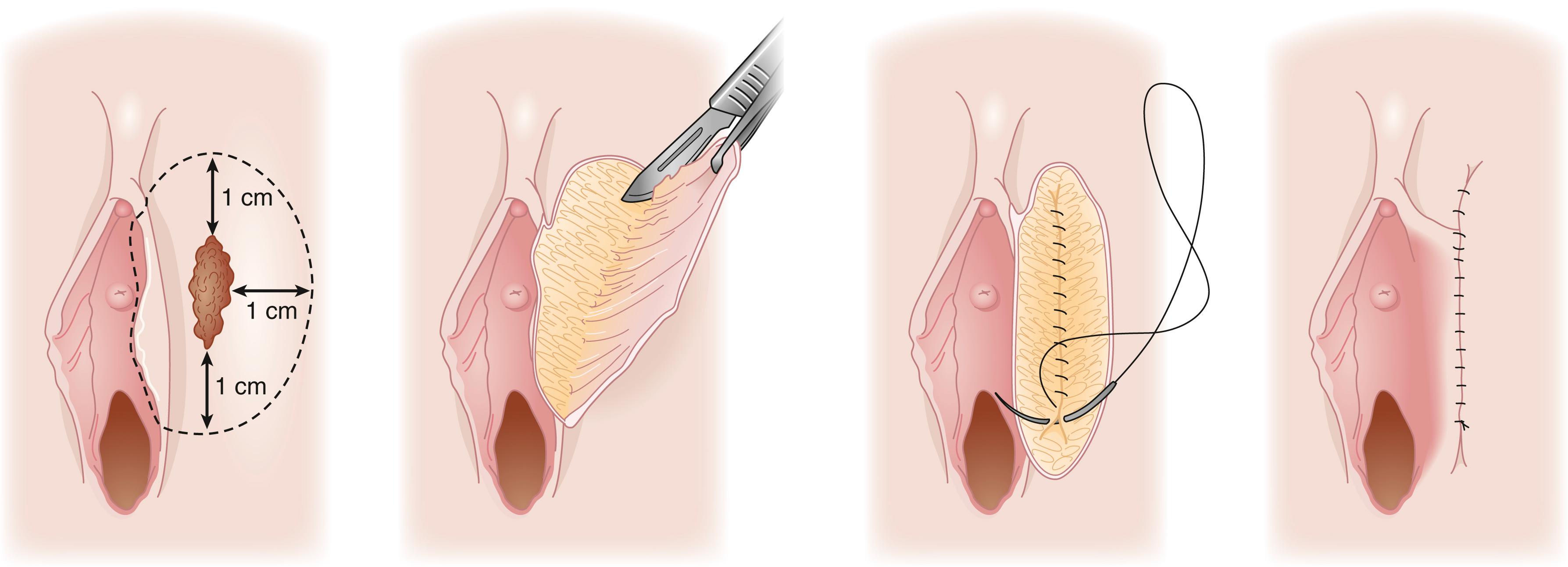 Fig. 71.7, Wide local excision of vaginal intraepithelial neoplasia lesion.