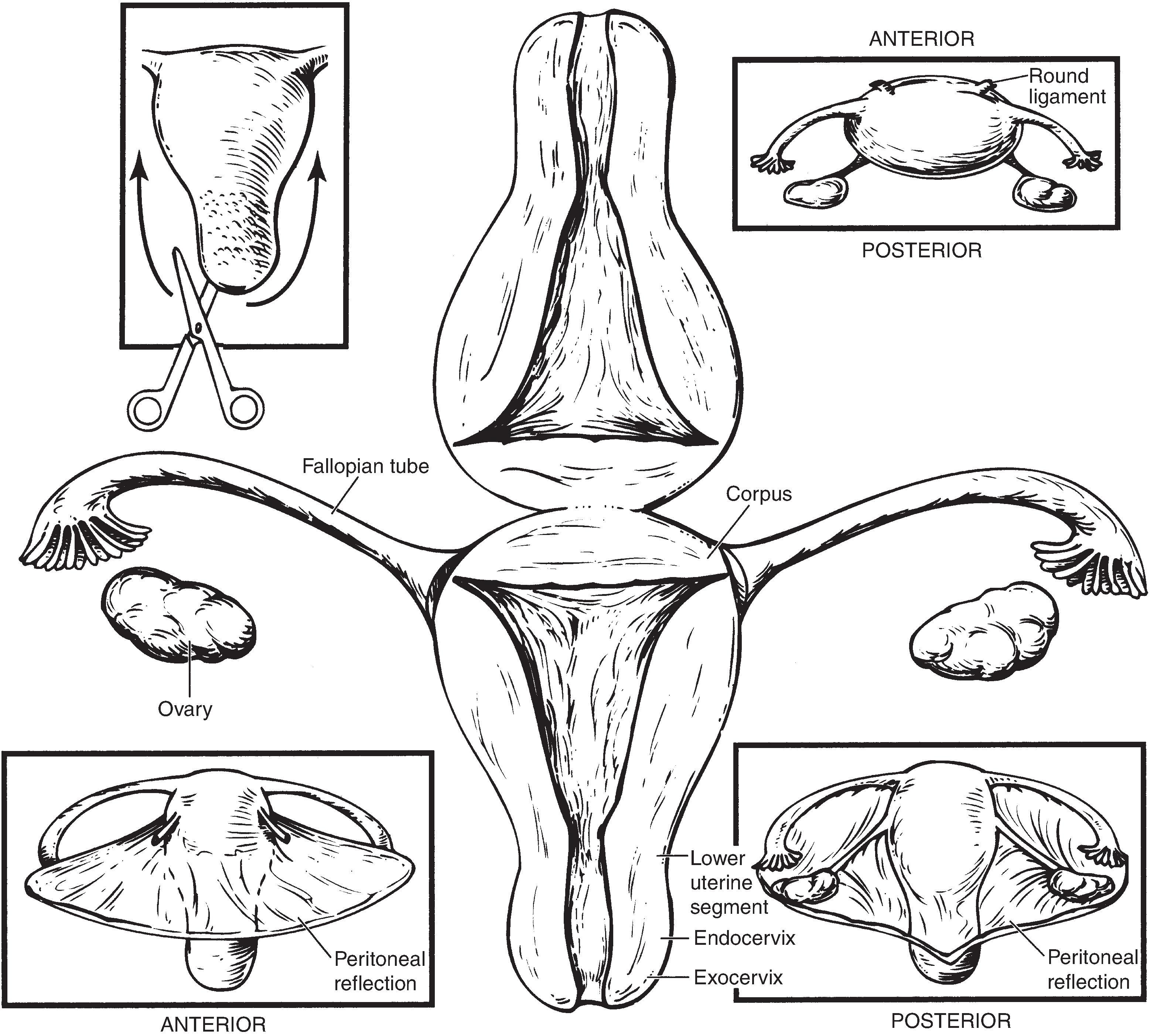 Figure 19.1, Total abdominal hysterectomy – orientation.