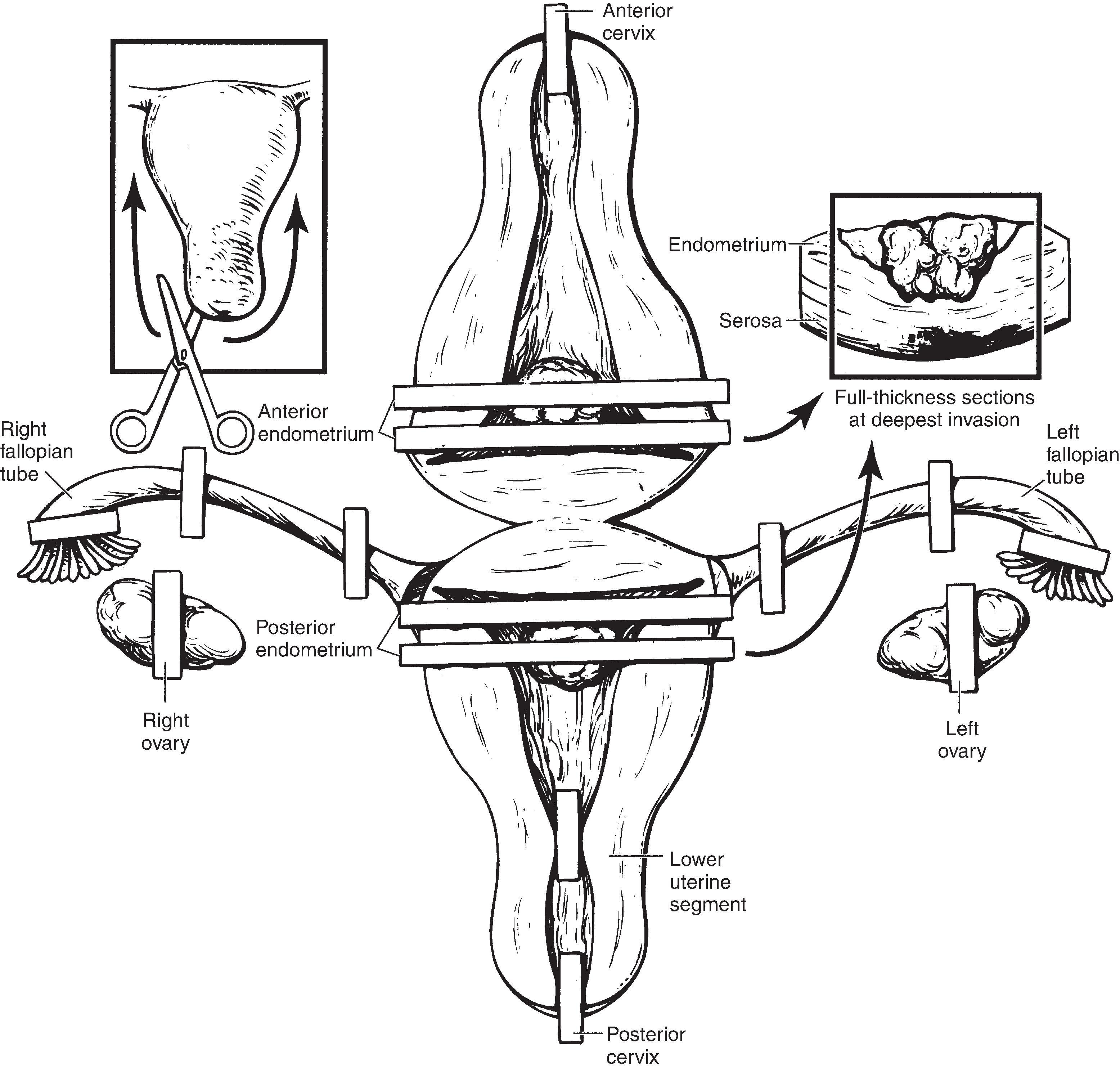 Figure 19.2, Total hysterectomy for malignant uterine tumors.