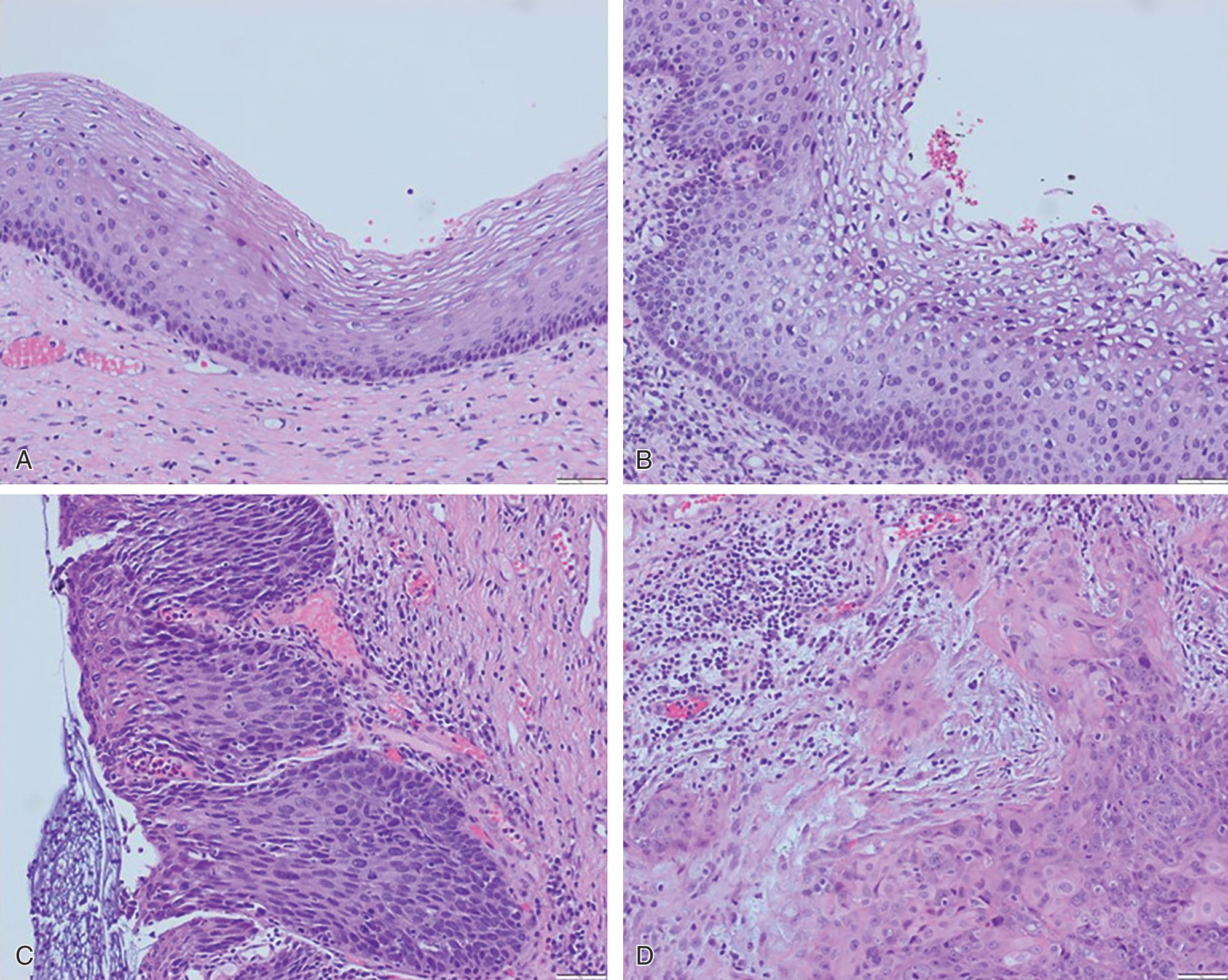 Fig. 2.4, Histology of normal cervix in contrast to low-grade squamous intraepithelial lesion (LSIL), high-grade squamous intraepithelial lesion (HSIL), and squamous cell carcinoma (SCC). A, Normal cervix shows maturation of the epithelium with increasing keratinization from basal to superficial epithelium; note the small size of superficial nuclei. B, LSIL shows maturation of the epithelium but with superficial koilocytes displaying nuclear enlargement and hyperchromasia along with cytoplasmic clearing. C, HSIL lacks epithelial maturation and mitotic figures are not restricted to the base, but the basement membrane is preserved. D, Invasive SCC lacks a basement membrane and shows stromal desmoplasia; small tumor nests detached from the main invasive front may also be noted.