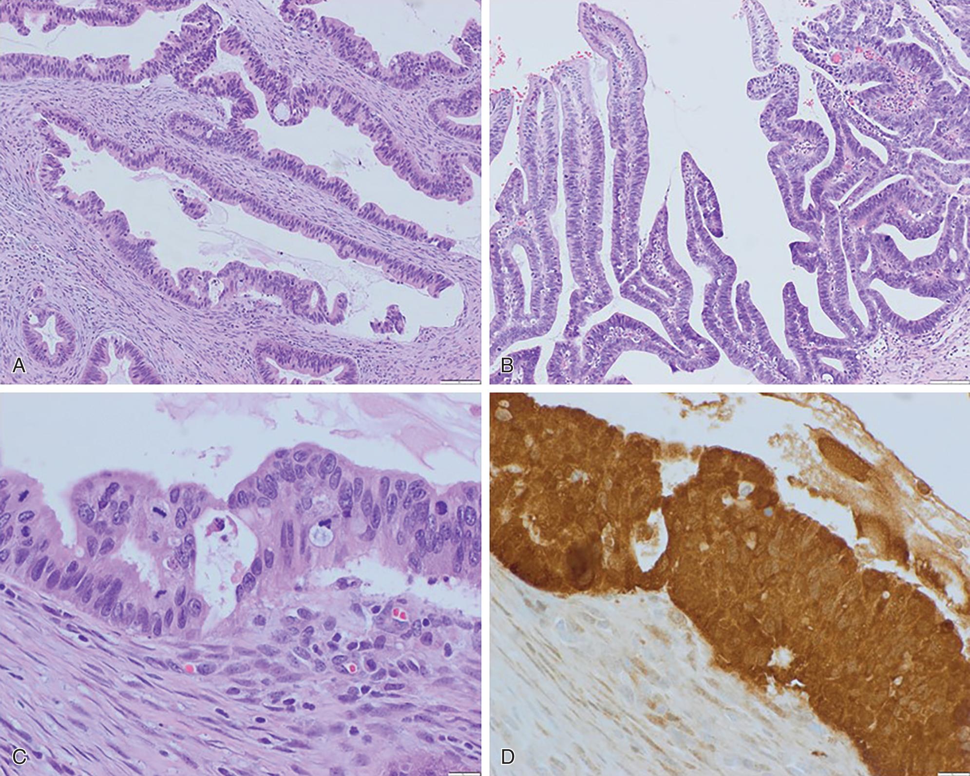 Fig. 2.5, Human papillomavirus–associated endocervical adenocarcinoma. Mitotic and apoptotic figures are easily appreciated at low power. A, Usual type. B, Villoglandular. C, High power showing apical mitosis. D, p16 immunohistochemical stain is positive (diffuse strong staining).