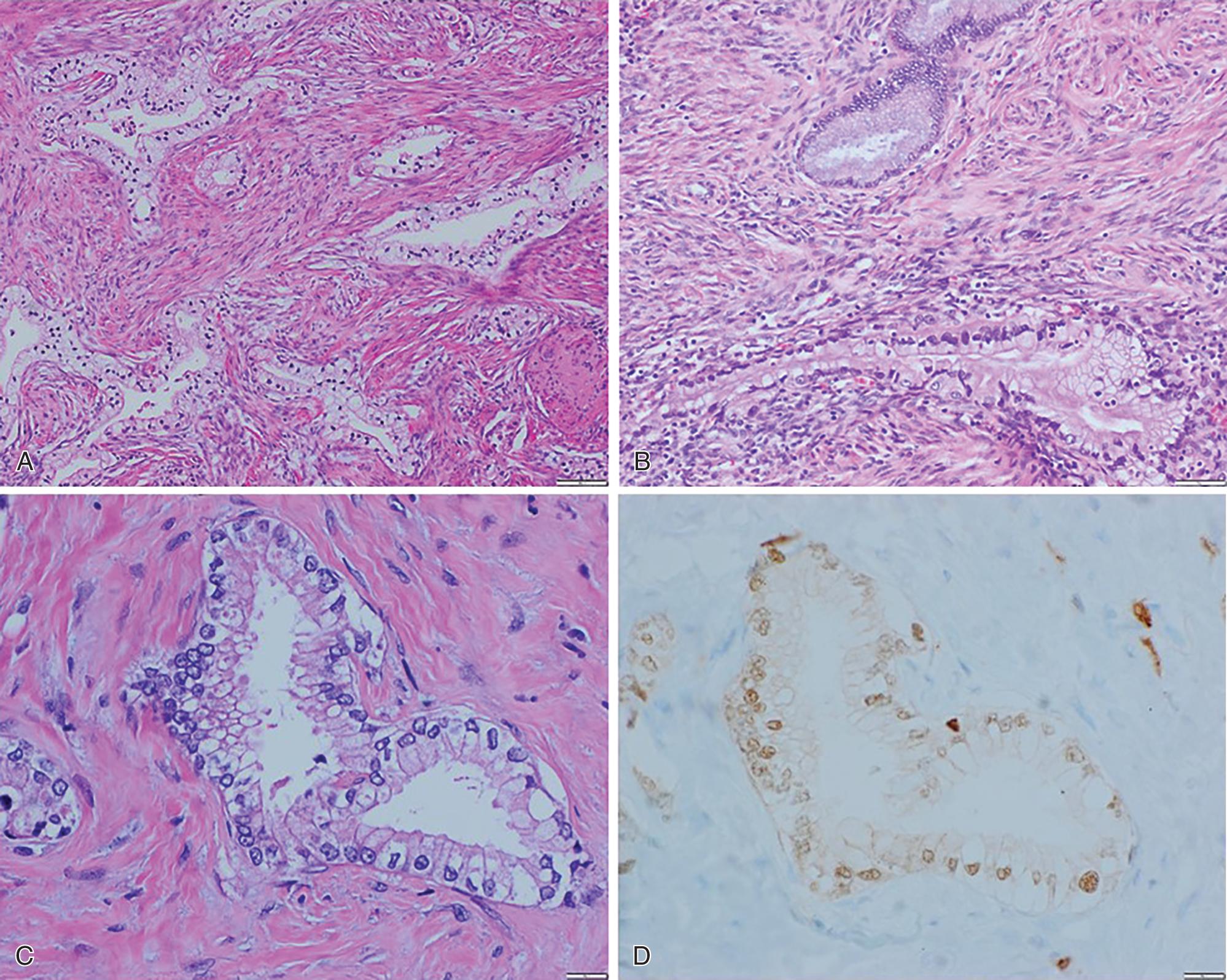 Fig. 2.6, Non–human papillomavirus-associated endocervical adenocarcinoma. Gastric type is the most common. Mitotic and apoptotic figures are NOT easily appreciated at low power. A, Low power. B, Medium power. Gastric-type adenocarcinoma (bottom gland) has pale/eosinophilic cytoplasm in comparison with the bluish/basophilic tinge of normal endocervical glands (top gland). C, High power showing tumor cells with pale cytoplasm and sharp cytoplasmic boundaries. D, p16 immunohistochemical stain is negative (patchy weak reactivity).