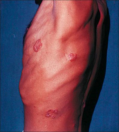 Figure 11-12, Hansen's disease (leprosy).