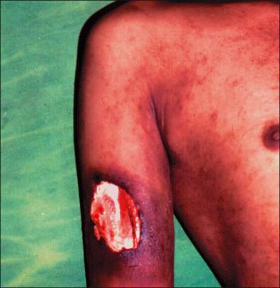 Figure 11-13, Cutaneous tuberculosis.