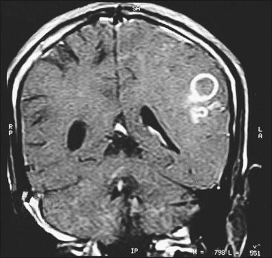 Figure 11-18, Tuberculoma.