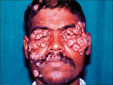 Figure 11-4, Molluscum contagiosum.