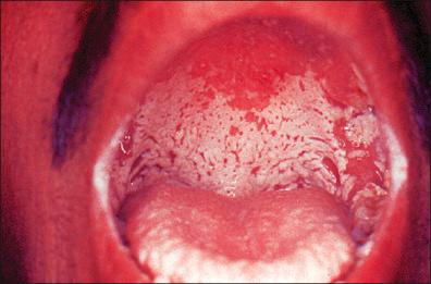 Figure 11-5, Oral candidiasis.