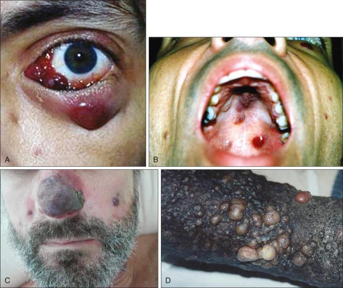 Figure 11-6, ( A ) Ocular KS; ( B ) oral KS; ( C ) cutaneous KS on nose; ( D ) verrucous KS.