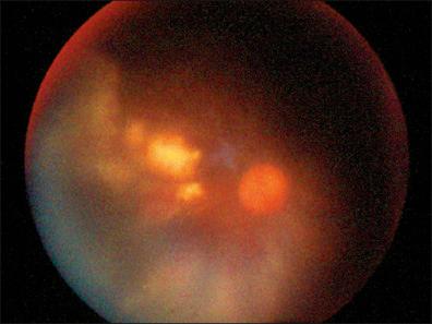 Figure 11-7, Cytomegalovirus (CMV) retinitis.