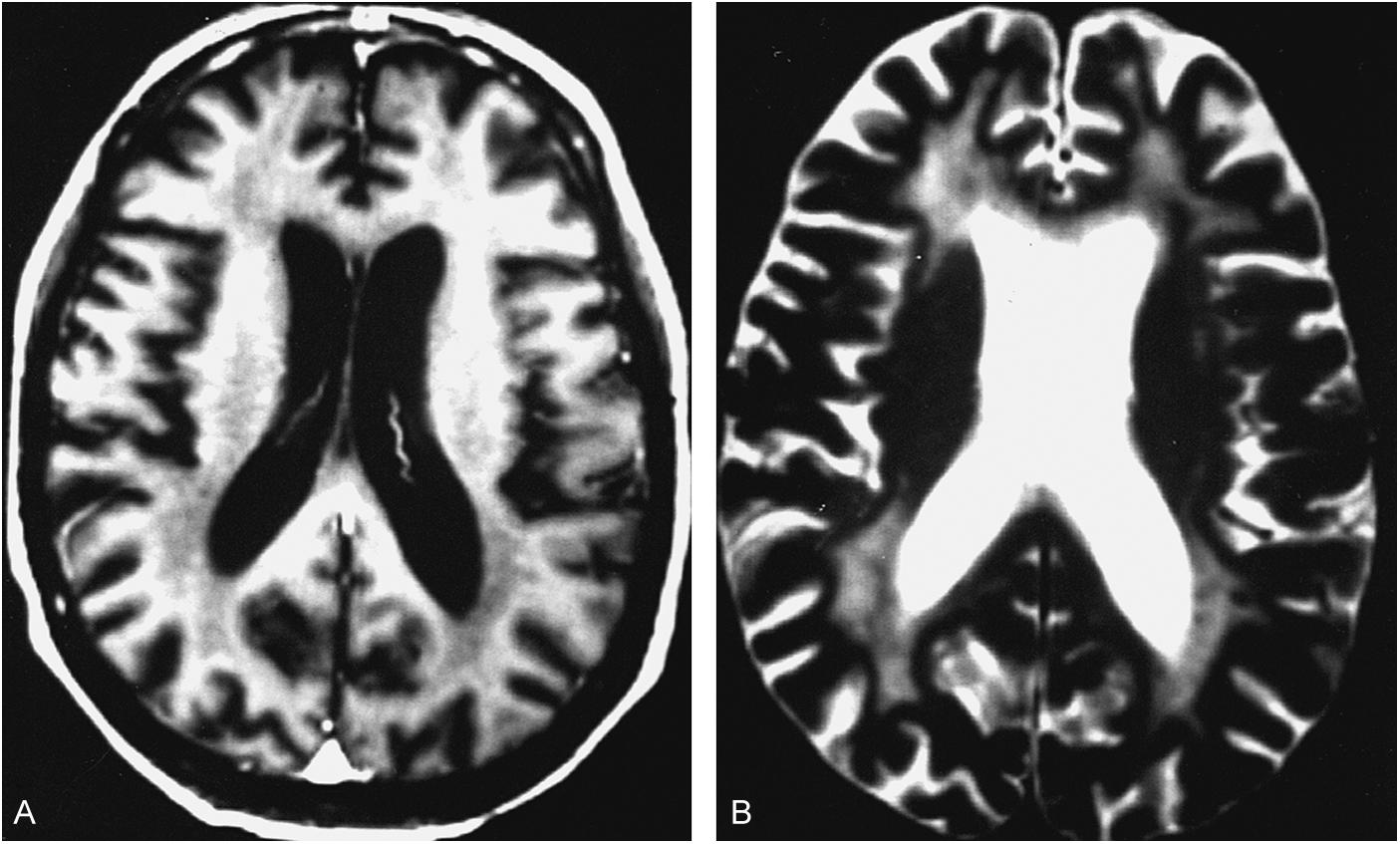 Figure 43-2, A , T1-weighted magnetic resonance image (MRI) of patient with HIV-associated dementia showing marked cerebral and cortical atrophy. B , T2-weighted MRI of the same patient showing extensive hyperintense signal abnormalities in the white matter.