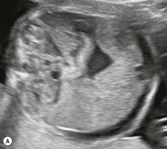 FIGURE 19-3, Transverse section of a fetus with (A) ascites and (B) pericardial effusion.