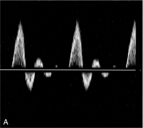 FIGURE 2-2, Femoral artery Doppler waveforms. (A) From a normal segment; the waveform has a smooth outline and the spectral width is low. (B) From the poststenotic region; in the early systolic phase the waveform has a clearly defined outline associated with the passage of blood which was at rest in the poststenotic region during diastole through the insonation site. In the later part of the waveform, blood which has passed through the stenosis has developed turbulent, disturbed flow with increased velocity. This appears as a region in which there is spectral broadening, with Doppler shifts above and below the baseline and high-frequency spikes.