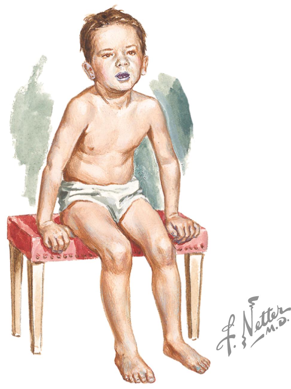 Fig. 4.1, Tripod position assumed by child with epiglottitis.