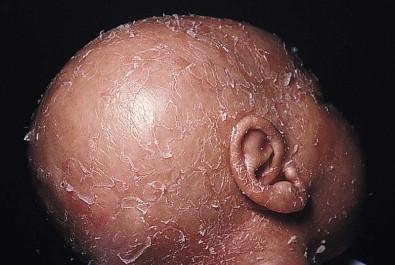 Figure 31.11, Absence of scalp hair, scale, and erythroderma in a neonate with Netherton syndrome.