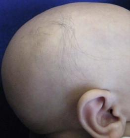 Figure 31.13, Nearly universal alopecia in a patient with atrichia with papular lesions.
