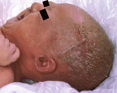 Figure 31.14, Scalp crusting and alopecia in ankyloblepharon–ectodermal dysplasia–clefting (AEC) syndrome.