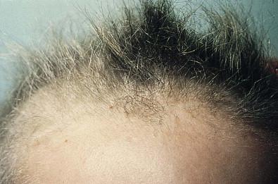 Figure 31.7, Short, broken, dull hair in trichothiodystrophy.